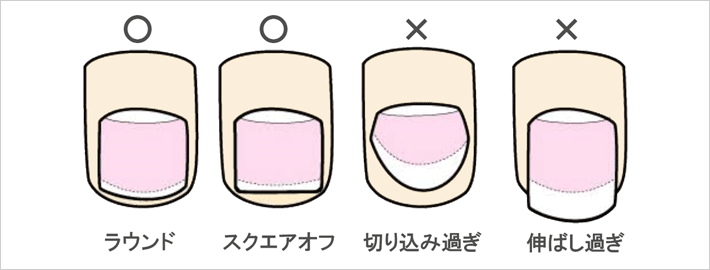 東京渋谷の巻き爪矯正セミナー 巻き爪を悪化させない切り方とは？